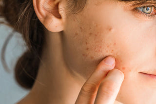 Acne Solutions - Close-up of a person with acne, highlighting skin texture. Ideal for acne treatment and skincare solutions.